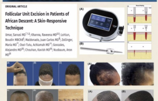 RELEASE: Technique Offers Hope for Hair Restoration...