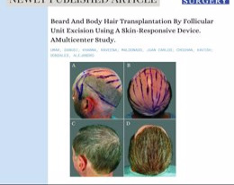 STATEMENT: New technology transforms baldness treatment...